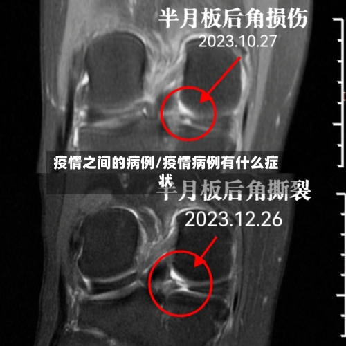 疫情之间的病例/疫情病例有什么症状-第3张图片