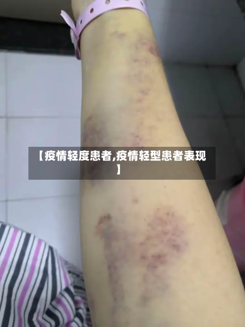 【疫情轻度患者,疫情轻型患者表现】