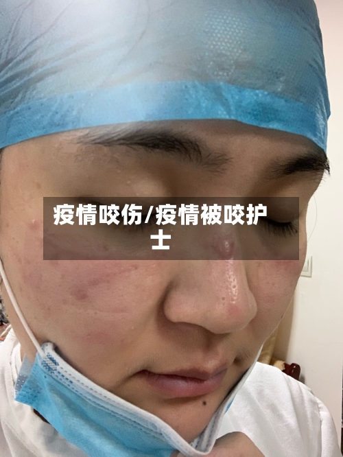 疫情咬伤/疫情被咬护士-第3张图片