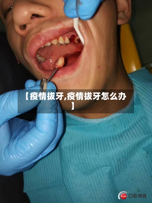 【疫情拔牙,疫情拔牙怎么办】-第3张图片